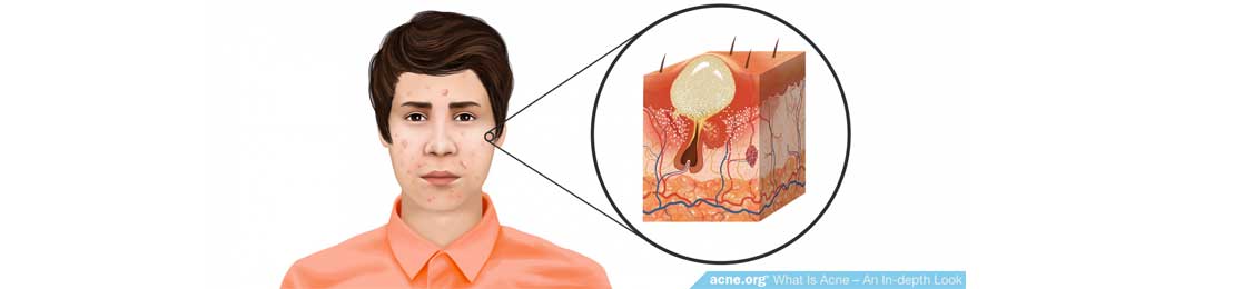 Tratar el acné desde el sistema inmunitario y la alimentación